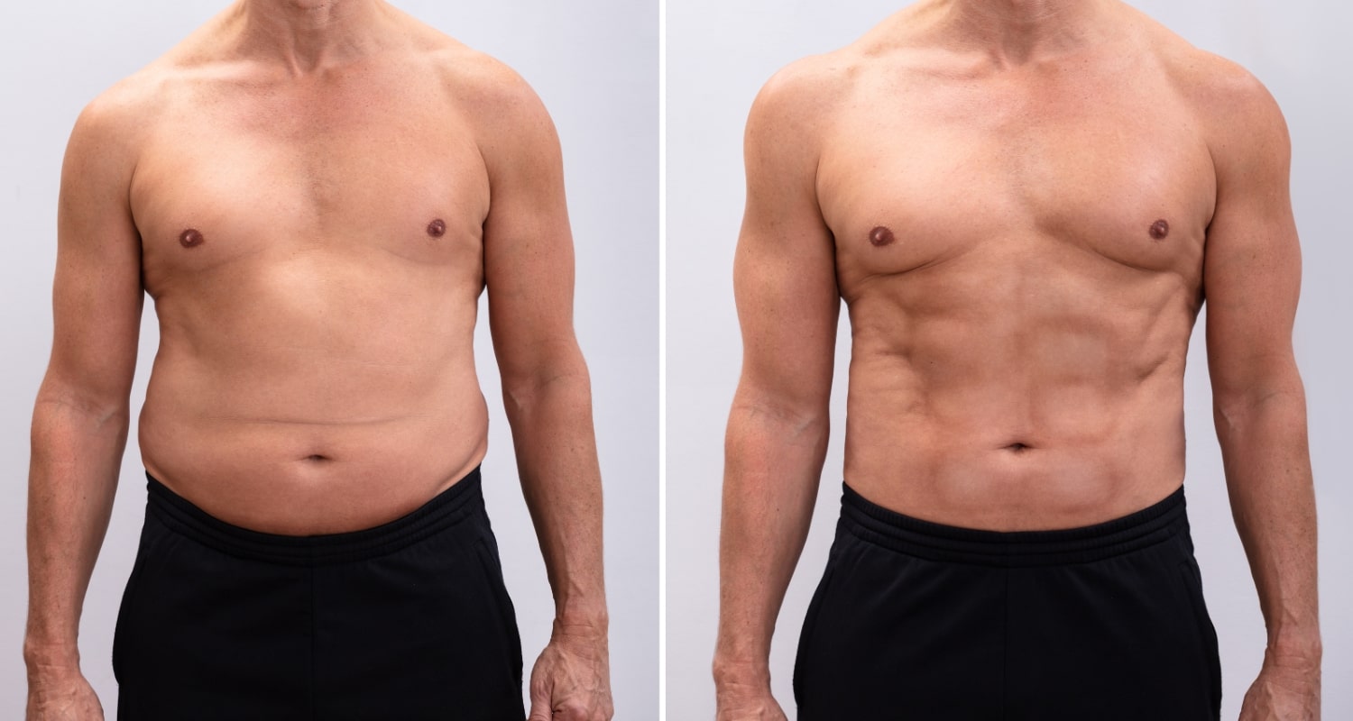 Липоскульптурирование для мужчин